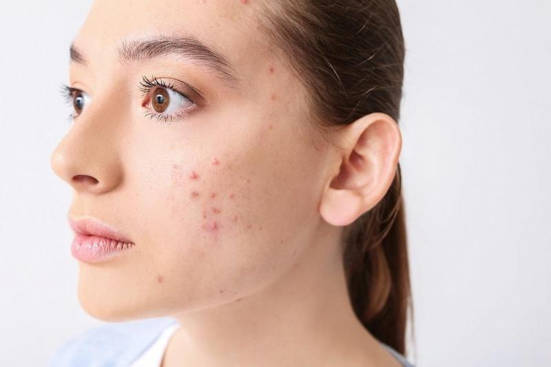 Understanding Adult Acne: Why It Appears After 30