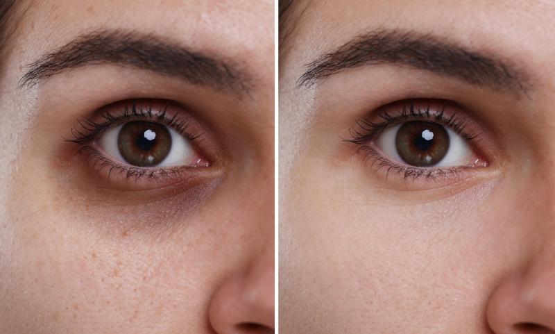 Discover the Best Doctor for Dark Circle Treatment in Hamra