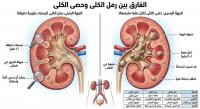 الحصى والترسبات الحصى والترسبات