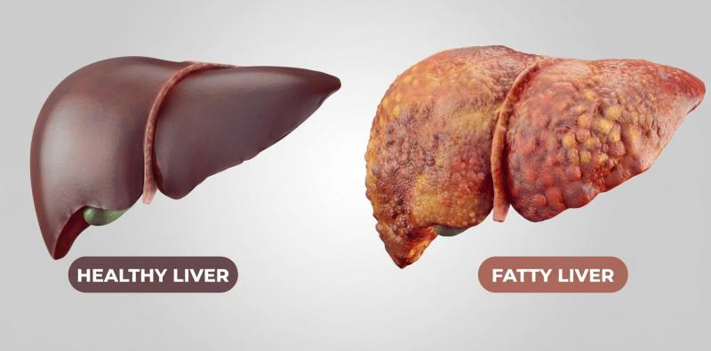 Symptoms That May Uncover Fatty Liver Disease