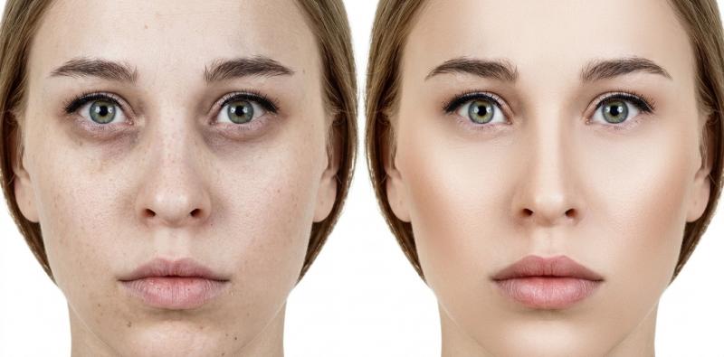 Understanding Dark Circles: Five Potential Causes