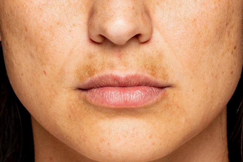 Understanding Skin Pigmentation: Causes and Solutions