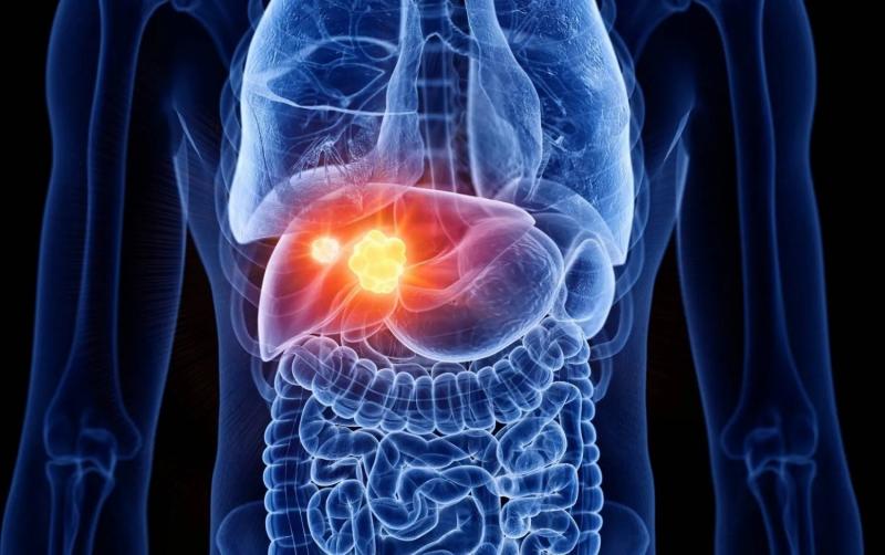 Russian Scientists Develop Innovative Liver Cancer Treatment
