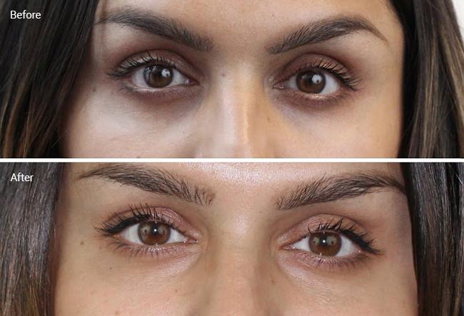 Ultimate Guide: How to Eliminate Dark Circles Under Your Eyes