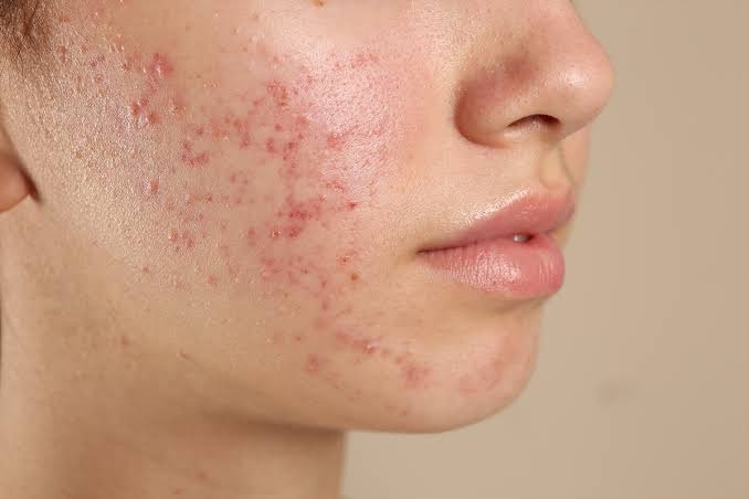 Causes of Acne on Cheeks: Understanding Triggers and Prevention