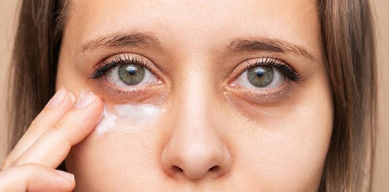 How to Permanently Get Rid of Dark Circles?