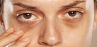 Dark circles Dark circles