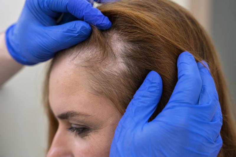 Causes of Hair Loss in Women: A Comprehensive Guide