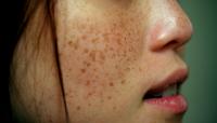 Pigmentation on the face Facial pigmentation