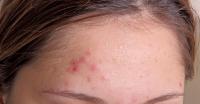 Causes of pimples on the forehead Causes of acne on the forehead
