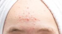 Reasons for the appearance of pimples on the forehead Causes of pimples appearing on the forehead