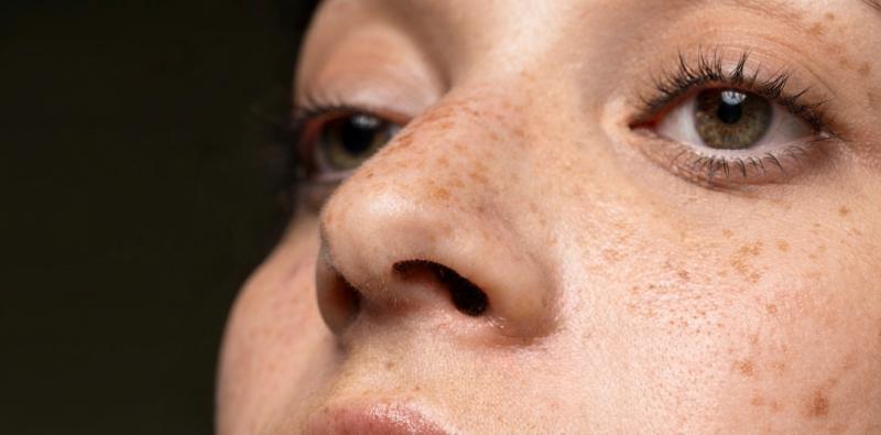 Understanding Facial Pigmentation: Causes and Prevention