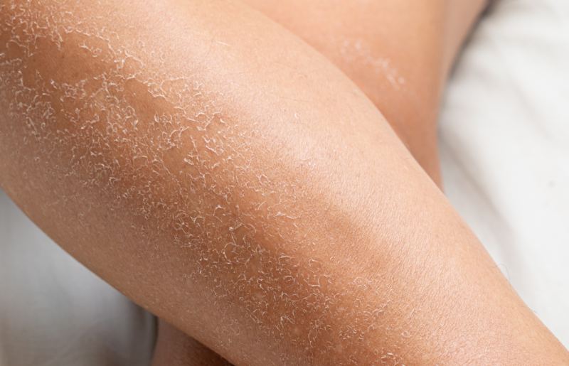 Essential Tips to Prevent Dry Skin This Fall