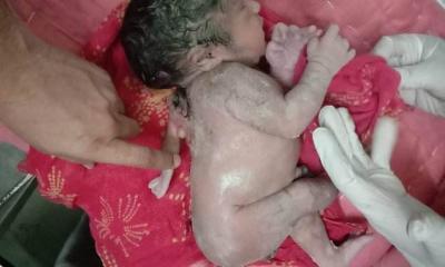 حالة طبية نادرة... ولادة طفل في الهند مع ذراع ثالثة في ظهره
