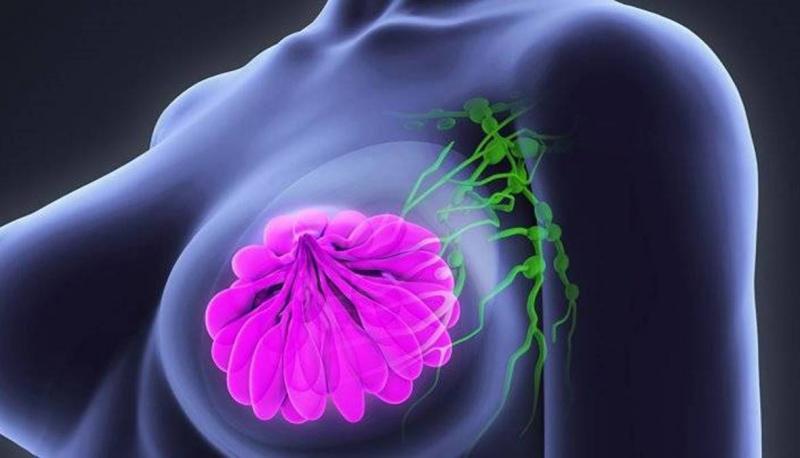 تجميد الأورام.. علاج جديد وواعد لسرطان الثدي