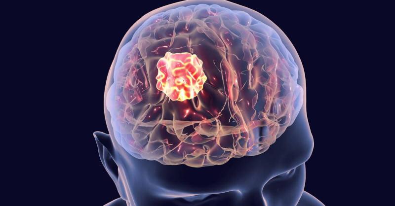 6 أعراض قد تدل على وجود ورم في الدماغ