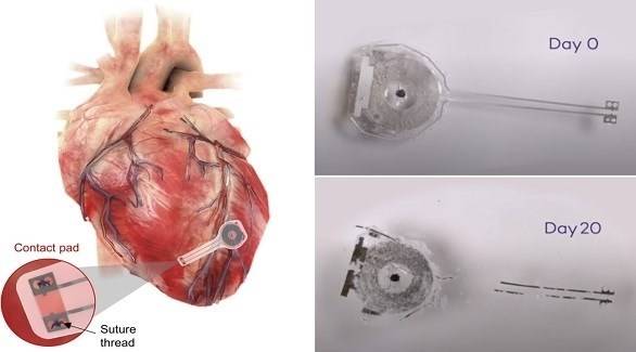 علماء يطورون أول جهاز لاسلكي لتنظيم ضربات القلب