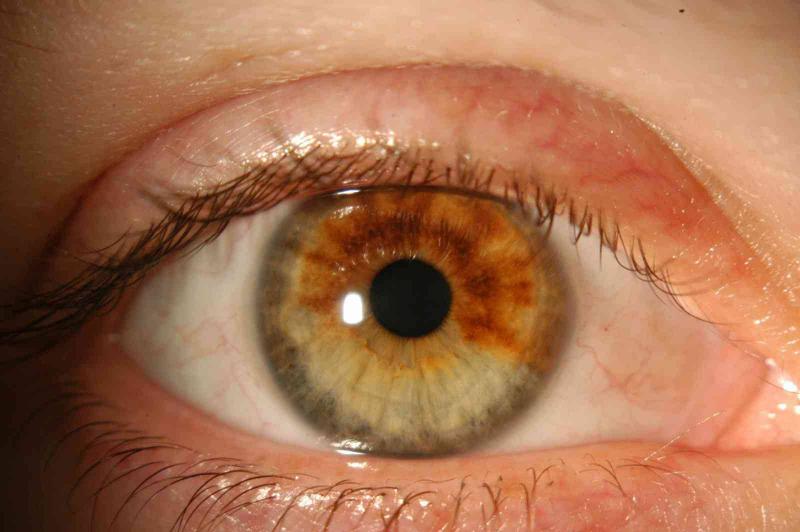 أعراض غير واضحة لسرطان العين